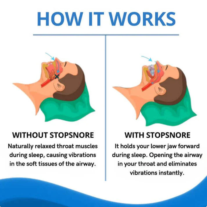 StopSnore™ Anti-Snoring Device